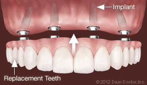 Independence, MO dental implants all-on-4