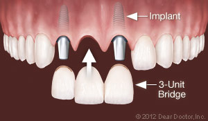 Independence, MO dental implants 3 unit bridge