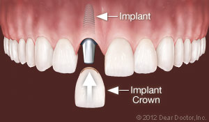 Independence, MO Dental implants diagram