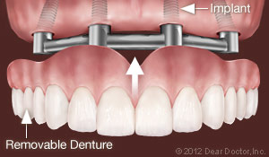 Independence, MO dental implants supported denture